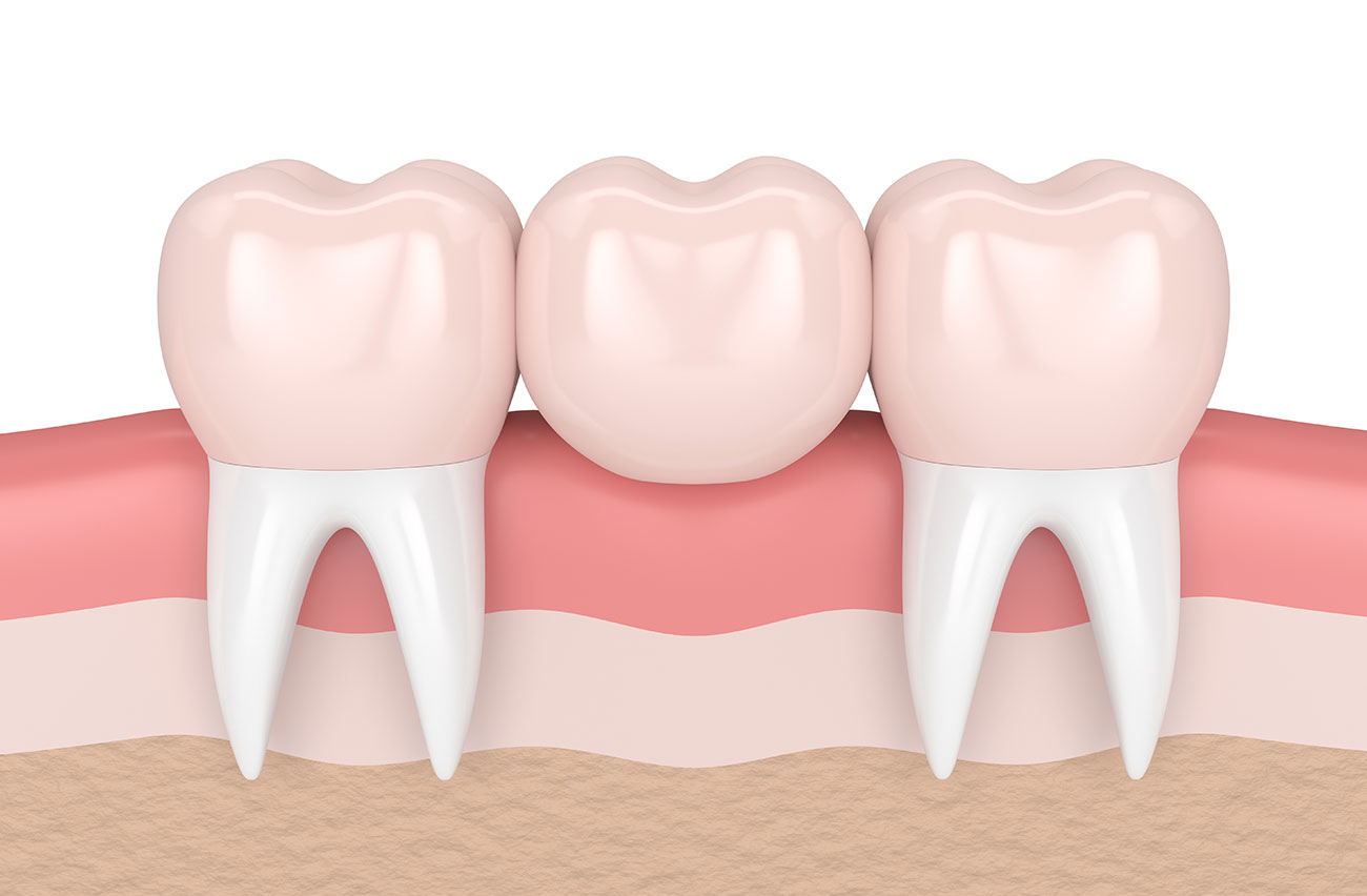 https://smilesplusmn.com/wp-content/uploads/2023/04/dental-bridge-porcelain-santa-barbara-ca.jpg
