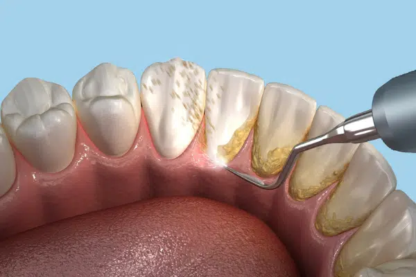 https://smilesplusmn.com/wp-content/uploads/2023/05/need-to-know-about-teeth-cleaning.webp